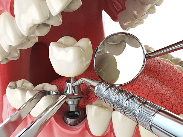 Best Emergency Dental Extractions in Kalona, IA